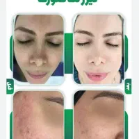 اولین مرکز لیزر با دو مدل دستگاه لیزر شاتی و رولی|خدمات آرایشگری و زیبایی|نجف‌آباد, باغ ملی|دیوار