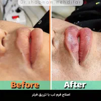 فیلر لب توسط پزشک