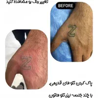 رفع تیرگی بدن  و لیزر تتوهای قدیمی بدن و صورت|خدمات آرایشگری و زیبایی|یاسوج, |دیوار