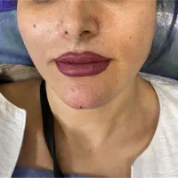 ژل لب فیلر نخ بوتاکس ۷۰۰
