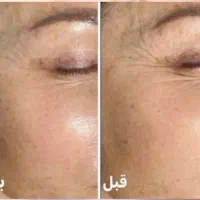 کرم بوتاکس|آرایشی، بهداشتی، درمانی|مراغه, |دیوار