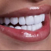 ایمپلنت-لمینت-کامپوزیت اقساط-گارانتی- دندانپزشکی|خدمات آرایشگری و زیبایی|مشهد, سجاد شهر|دیوار