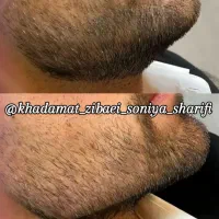 تخفیف ویژه ژل و بوتاکس تا یک هفته