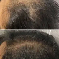 قطع ریزش مو و رویش مجدد مو