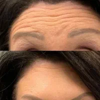 مدل ژل و بوتاکس|خدمات آرایشگری و زیبایی|شیراز, ملاصدرا|دیوار