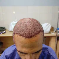 کاشت مو. و ابرو. . پی ار پی و مزو تراپی سر و صورت