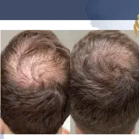 پی آر پی (prp)  *  مزوتراپی  *  کاشت مو و ابرو