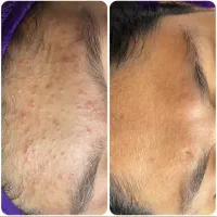 آموزش،پی ار پی مزوبوتاکس بایوفیلر غبغب چربی ساکشن|خدمات آرایشگری و زیبایی|اصفهان, شاهزید|دیوار