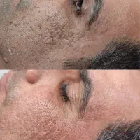 درمان کامل جای  زخم ‌. اسکار .جای جوش