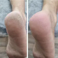 پدیکور تخصصی با تخفیف ۳۰٪