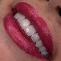 کامپوزیت لمینیت ایمپلنت+تخفیف ویژه+ اقساط ۱ ساله