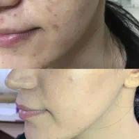 آموزش فشیال پاکسازی پوست الهیه بامدرک تضمینی|خدمات آموزشی|کرمانشاه, |دیوار