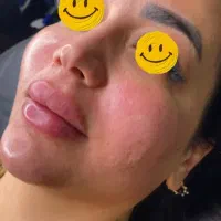 خدمات بوتاکس و فیلر و پیرسینگ