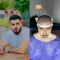 کاشت مو پرتراکم تضمینی بدون جراحی فقط ۱۵ میلیون