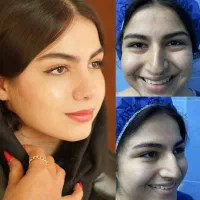 جراحی بینی درتهران/جشنواره ویژه مراجعین بوئین زهرا