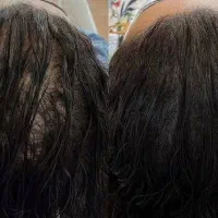 آموزش و خدمات میکرواسکالپ ،اسکراب ،مکمل کاشت مو|خدمات آرایشگری و زیبایی|مشهد, صیاد شیرازی|دیوار