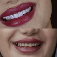 چشنواره‌پاییزه‌کامپوزیت‌ولمینت‌دندان‌