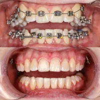 ارتودنسی ثابت و متحرک با اقساط بلند مدت|خدمات آرایشگری و زیبایی|میانه, |دیوار