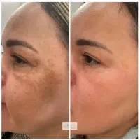 کرم بیوممتیک چین و چروک (جایگزین بوتاکس)تخفیف ویژه