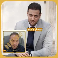 جشنواره تابستانه کاشت مو، ابرو و بلفاروپلاستی