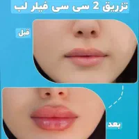 50٪تخفیف خدمات فیلر بوتاکس مزوتراپی پرسینگ چال لپ|خدمات آرایشگری و زیبایی|اصفهان, مولوی|دیوار