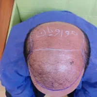 کاشت مو لیزری