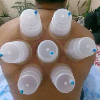 حجامت معجزه میکنه|آرایشی، بهداشتی، درمانی|بندر کنگان, |دیوار