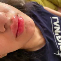 تزریق فیلر و بوتاکس لیفت نخ مزو و...|خدمات آرایشگری و زیبایی|مشهد, گلشور|دیوار