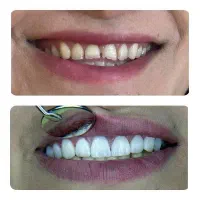 کامپوزیت دندان کامپوزیت زیبایی ونیر|خدمات آرایشگری و زیبایی|قم, چهار امامزاده|دیوار