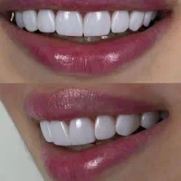 کامپوزیت دندان قیمت های مناسب|خدمات آرایشگری و زیبایی|اهواز, کیانپارس |دیوار