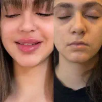 تخفیف ویژه به مدت ۲ روز مزو فیلر ژل بادی هیپ دیپ|خدمات زیبایی و سلامت|تبریز, |دیوار