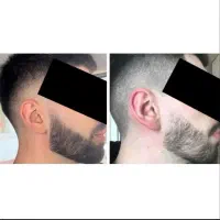 ریش تراپی