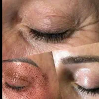 خالبرداری فقط۵۰کوچک کردن بینی  خط خنده اخم پیشانی