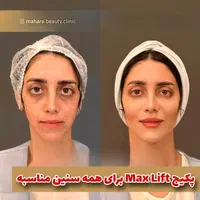 جشنواره جوانسازی Max Lift پزشک پوست مو بینی زیبایی|خدمات آرایشگری و زیبایی|مشهد, هفت تیر (حافظ)|دیوار
