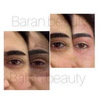 خال،زگیل،میخچه،جوانسازی، رفع چین چروک|خدمات آرایشگری و زیبایی|زاهدان, |دیوار