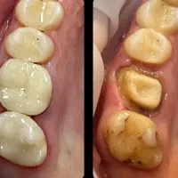 ترمیم و پرکردن دندان فقط ۳ میلیون