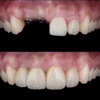 دندانپزشکی ایمپلنت تخصصی از ۵ میلیون اقساطی وام