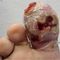 درمان دیابت به صورت تضمینی و تخصصی|خدمات آرایشگری و زیبایی|زرند, |دیوار