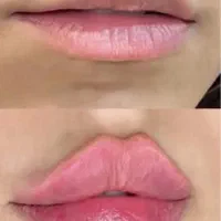 تزریق فیلر و بوتاکس ومزوتراپی