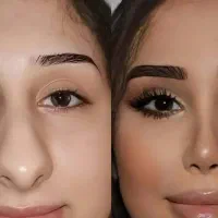 عمل زیبایی سینه بلفاروپلاستی بینی