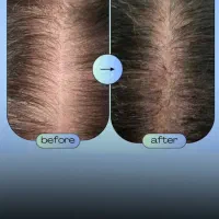 جشنواره تخفیفی ژل و بوتاکس/وام/اقساطی|خدمات آرایشگری و زیبایی|ساری, |دیوار