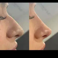 لیفت کامل بینی(اواتار) بدون جراحی به روش (NOA)
