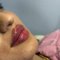 تزریق ژل و بوتاکس مزو جوانساز