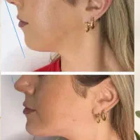 تزریق ژل و بوتاکس فقط قیمت مصرفی بمدت محدود