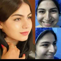 انواع عمل زیبایی بینی.غبغب.بلفارو.ژل.بوتاکس