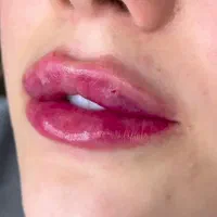 ژل بوتاکس مزوتراپی فیلرکانتورینگ|خدمات آرایشگری و زیبایی|چهارباغ, |دیوار