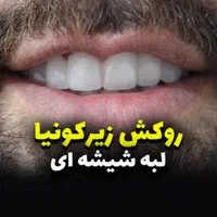 روکش زیرکونیا/ایمپلنت کره ای/ونیر|خدمات آرایشگری و زیبایی|بابل, |دیوار