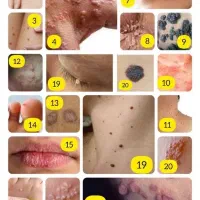 زگیل و تبخالتو درمان کن