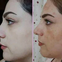 کرم سفید کننده،ضد لک،ضد جوش صورت و دست و پا|آرایشی، بهداشتی، درمانی|درگهان, |دیوار