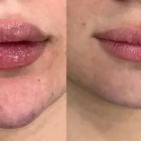 ژل وبوتاکس ومزولایک